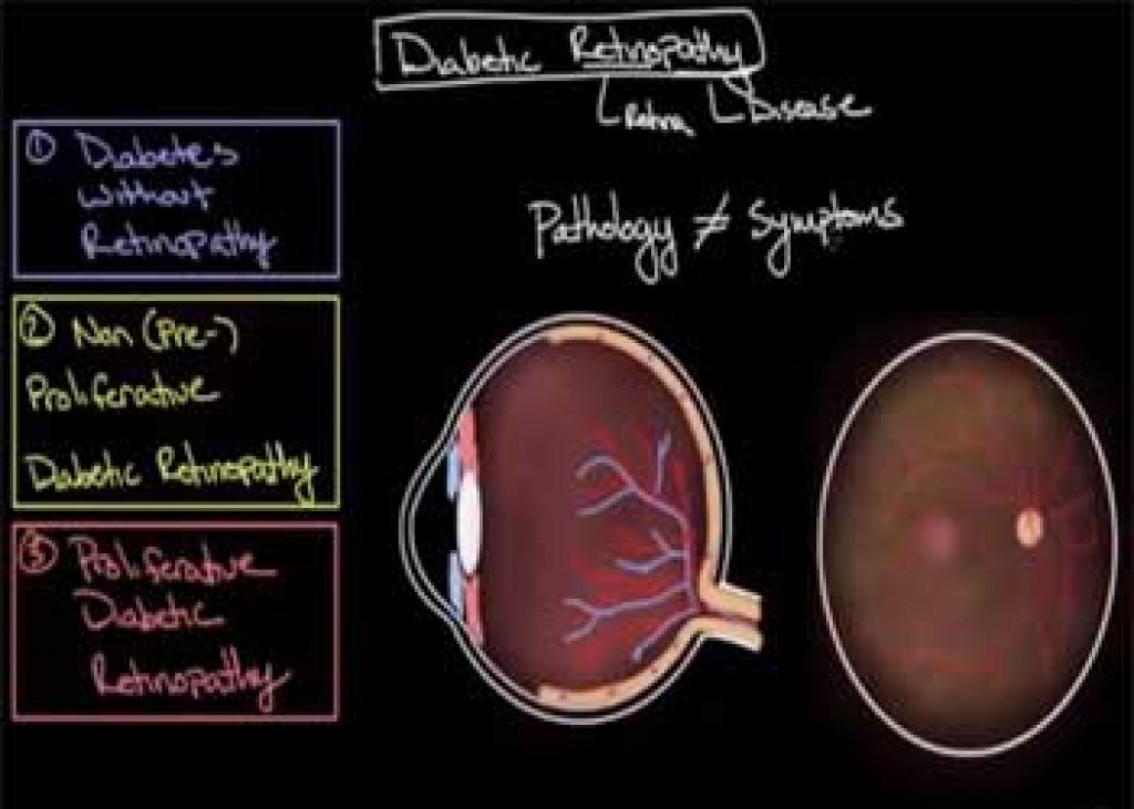 Diabetic retinopathy Diabetic retinopathy