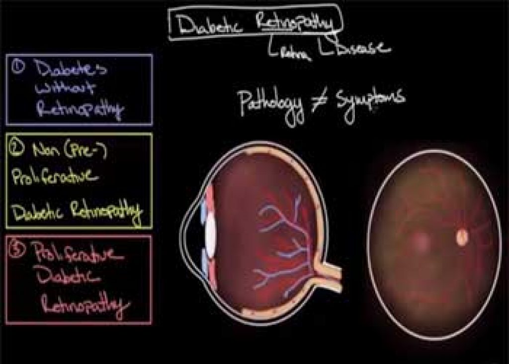 Diabetic retinopathy