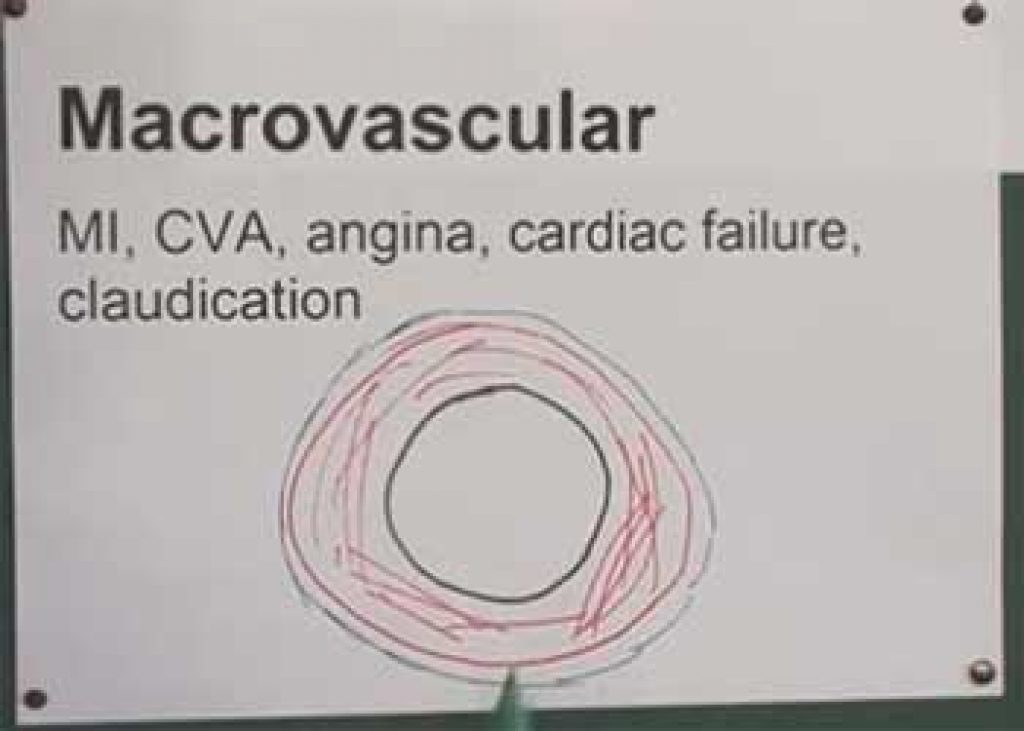 What Causes the Microvascular Complications in Patients with Diabetes Mellitus? 2 Prevention of microvascular complications