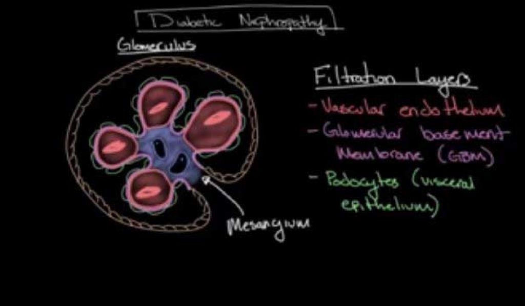 Diabetic nephropathy Diabetic nephropathy